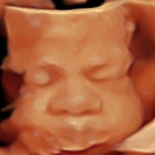 3D ultrasound image of a baby's face captured at UBM Scans