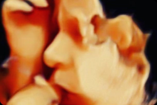 3D ultrasound image captured during a UBM Scans session