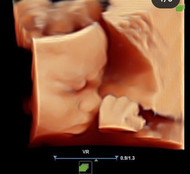 4D ultrasound of a baby shown live on the scan monitor