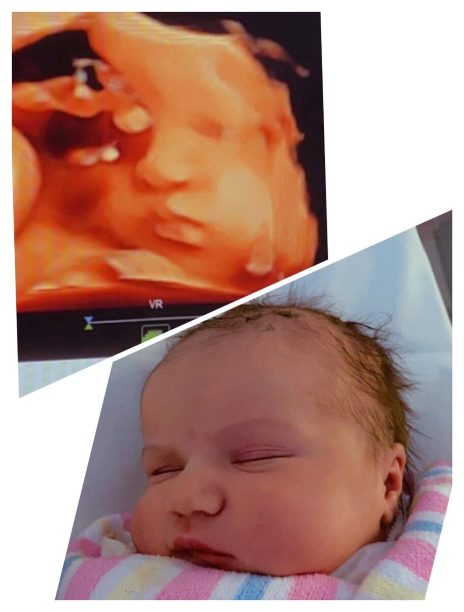 A 3D ultrasound of a baby’s face beside a photograph of the same baby as a newborn