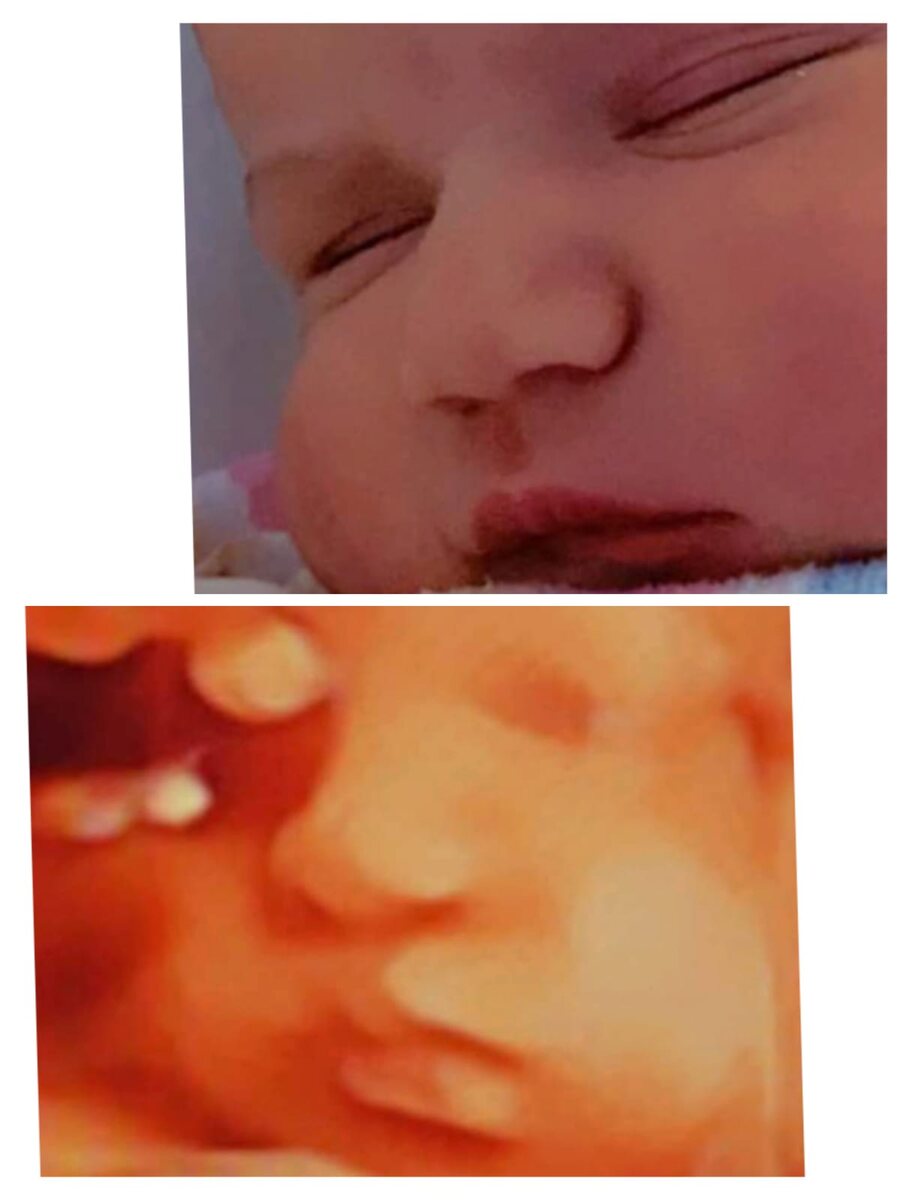 A newborn’s face photographed beside the 3D ultrasound taken before birth