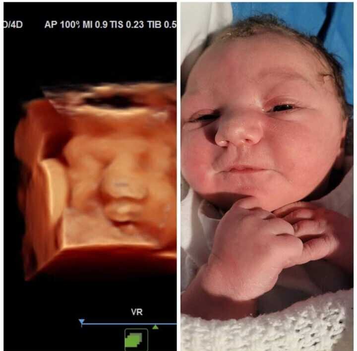A 3D ultrasound scan beside a photograph of the same baby shortly after birth