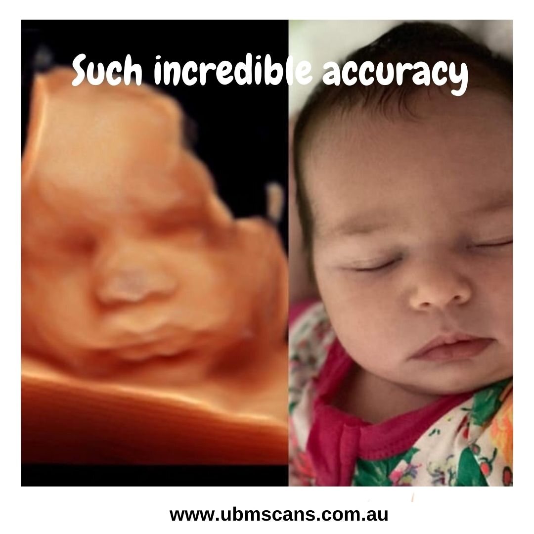 A 3D ultrasound face beside a photograph of the same baby asleep after birth